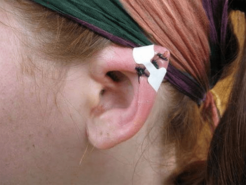 Precio de cirugía de oído elfo - en 2022 - 7 - julio 14, 2022