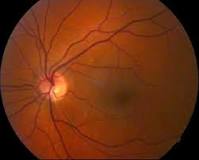 Vista Restablecida: Una Mirada a la Trombosis Ocular - 31 - enero 9, 2023
