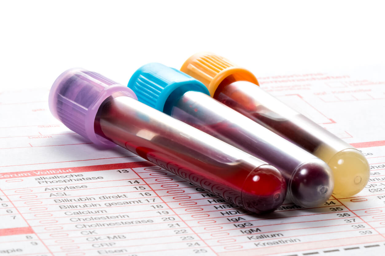 ¿Qué significa PDW bajo en el análisis de sangre? - 5 - enero 10, 2023