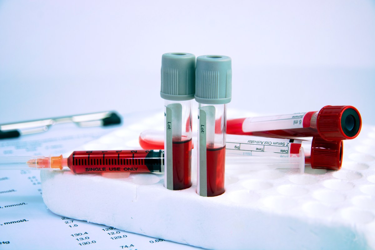 ¿Qué significa PDW bajo en el análisis de sangre? - 7 - enero 10, 2023