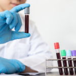 ¿Qué significa PDW bajo en el análisis de sangre?