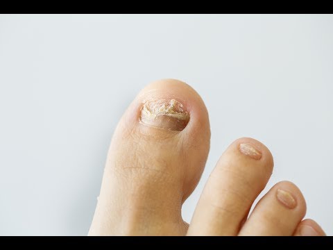 Tratamiento anti hongos en uñas de pies - 3 - marzo 24, 2022