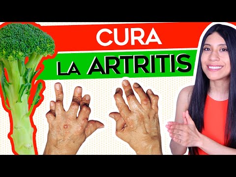 Como curar la artritis en 3 semanas - 31 - abril 16, 2022